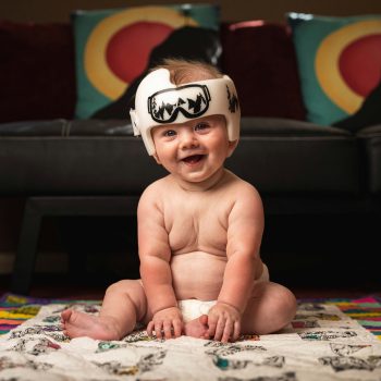 Plagiocephaly